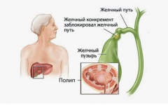 Полип желчного пузыря    – причины, симптомы, лечение и профилактика